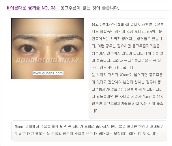 [두한성형외과 NO.1 눈성형] - [일반적인 기준의 아름다운 쌍꺼풀 모음] 관련 이미지 3