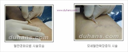 [두한성형외과 경쟁력 정맥류 치료] - [정맥류 치료의 모든 것] 관련 이미지 10