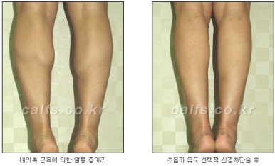 [두한성형외과 종아리수술] - [종아리성형 실패의 원인] 관련 이미지 4