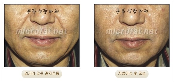 [두한성형외과 경쟁력 안티에이징 동안성형] - [주름이 깊은 푹~ 꺼진 입가 팔자주름 안녕!] 관련 이미지 21