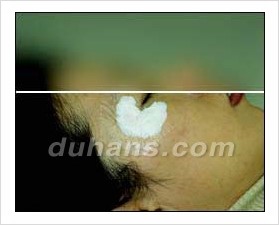 [두한성형외과 경쟁력 안전성형] - [최첨단 장비를 이용한 흉터, 점, 주근깨, 잡티, 문신제거 레이저 시술] 관련 이미지 16