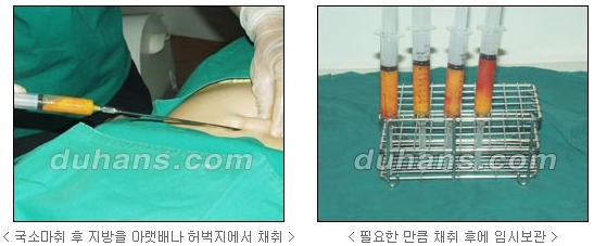 [두한성형외과 얼굴자가지방이식] - [코지방이식] 관련 이미지 5