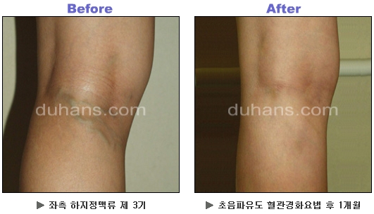 [두한성형외과 정맥류] - [하지정맥류, 정맥확장증, 혈관확장증] 관련 이미지 24