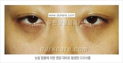 [두한성형외과 경쟁력 눈밑성형] - [눈밑 다크써클 원인과 눈밑 다크써클 치료 방법 안내] 관련 이미지 6