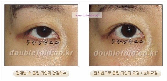 [두한성형외과 경쟁력 쌍꺼풀 재수술] - [풀린 라인 교정(Correction released fold line) 방법] 관련 이미지 3