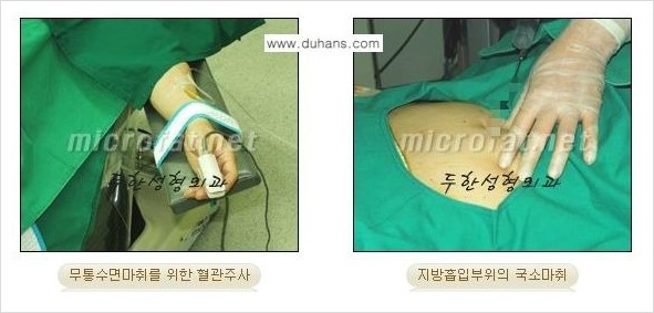 [두한성형외과 경쟁력 바디성형] - [하복부, 팔뚝, 허리선, 허벅지, 엉덩이 간편지방흡입술] 관련 이미지 3