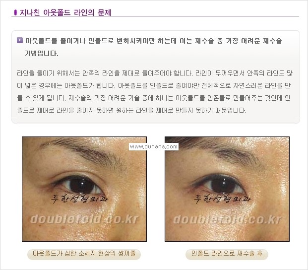 [두한성형외과 경쟁력 쌍꺼풀 재수술, 극한 재수술] - [쌍꺼풀 재수술, 극한 재수술 시 문제점 안내] 관련 이미지 4