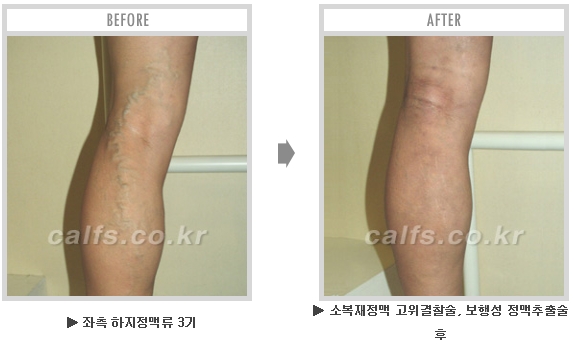 [종아리성형 두한성형외과] - [종아리수술에 대한 자주하는 질문과 답변 모음] 관련 이미지 16