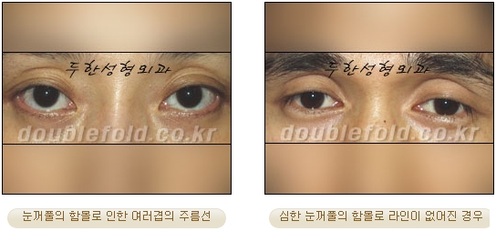 눈성형잘하는곳 두한성형외과 - 겹쌍꺼풀 관련 이미지 29
