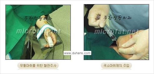 ​[두한성형외과 경쟁력 지방이식] - [지방이식 부작용 이후 마이크로 지방흡입, 마이크로 지방흡입 이후 부작용 없는 지방이식 방법] 관련 이미지 2