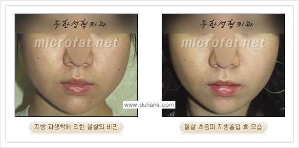 [두한성형외과 겨울엔 지방흡입을] - [볼살, 눈밑, 턱선의 초음파 미세지방흡입 2.] 관련 이미지 5
