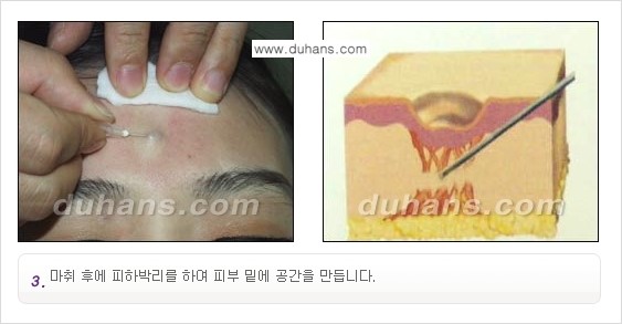 [두한성형외과 함몰 흉터 교정] - [동시에 3가지 시술로 효과적인 흉터의 교정 안내 ①] 관련 이미지 7