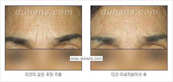 [두한성형외과 경쟁력 주름성형] - [지방이식을 이용한 이마주름, 미간주름 제거] 관련 이미지 14