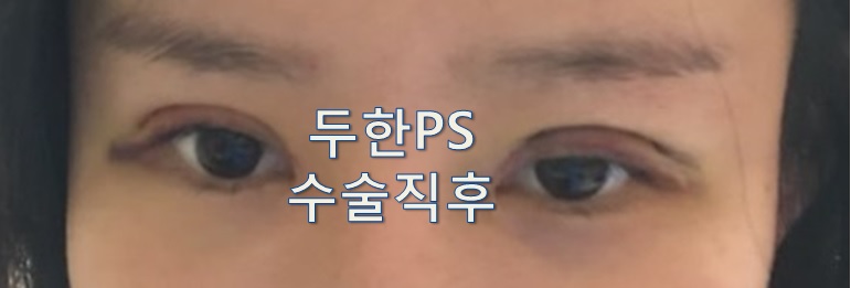 [두한성형외과 쌍꺼풀재수술]-[#라인키우기 #비대칭 #낮은라인 #울퉁불퉁 #짝눈] 관련 이미지 2