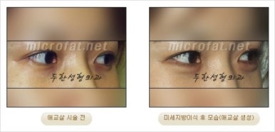 [두한성형외과 얼굴자가지방이식] - [지방이식 과정] 관련 이미지 34