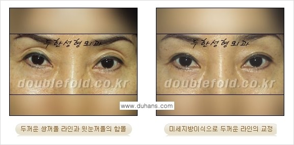 [두한성형외과 경쟁력 눈성형] - [미세지방이식으로 두꺼운 쌍꺼풀 라인의 교정 방법 안내] 관련 이미지 5