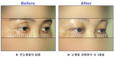 ​[두한성형외과 동안성형] - ​[하안검수술, 상안검수술, 눈썹거상술] 관련 이미지 85