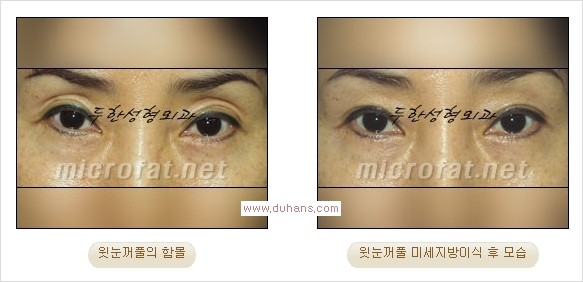 [두한성형외과 경쟁력 쌍꺼풀 재수술, 극한 눈재수술] - [어색한 쌍꺼풀 라인을 교정하는 윗눈꺼풀 미세지방이식] 관련 이미지 25