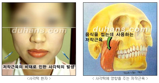 [두한성형외과 보톡스시술] - [사각턱 보톡스 안내] 관련 이미지 2