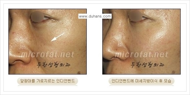 [두한성형외과 경쟁력 미세지방이식] - [귀족수술과 인디언밴드 교정 안내] 관련 이미지 18