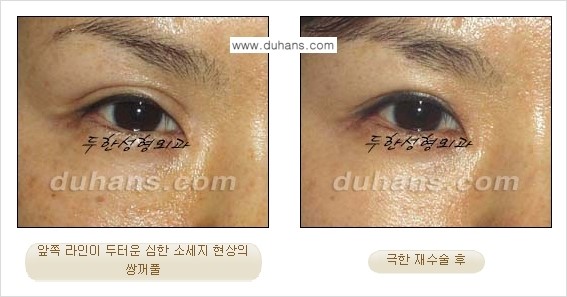 [두한성형외과 성형 FOCUS] - [정상적인 눈매로의 복원 극한재수술 경우 ②] 관련 이미지 10