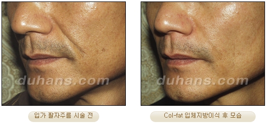[Duhan Plastic Surgery Facial Autologous Fat Grafting] - [Fat Grafting Guide] image 26