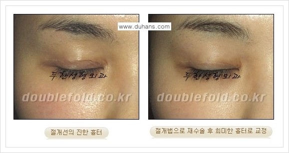 [두한성형외과 경쟁력 쌍꺼풀(눈) 재수술] - [쌍꺼풀 흉터선이 진한 경우의 안내] 관련 이미지 7