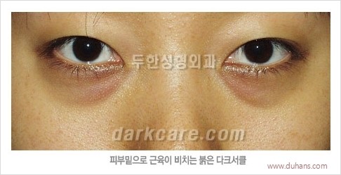 [두한성형외과 경쟁력 눈밑성형] - [다크써클의 원인과 다크써클의 종류] 관련 이미지 16