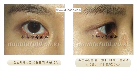 ​[두한성형외과 경쟁력 눈성형] - [재수술시 발생하는 여러 가지 문제점과 해결방법 안내] 관련 이미지 10
