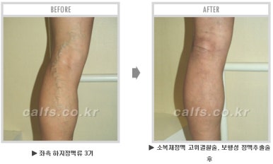 [종아리 두한성형외과] - [나에게 맞는 종아리시술] 관련 이미지 58