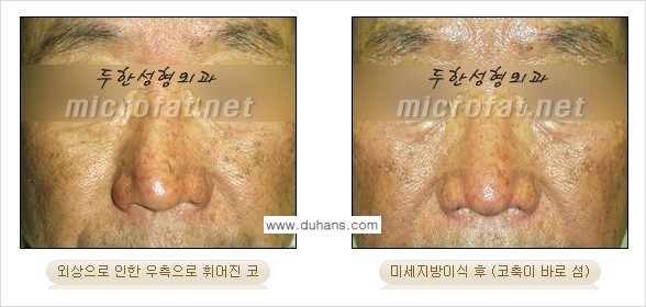 ​[두한성형외과의 No.1 경쟁력 미세(자가)지방이식] - [코높힘 미세(자가)지방이식 ②] 관련 이미지 11