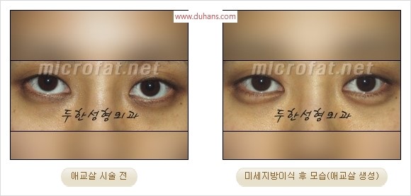 ​﻿[두한성형외과 경쟁력 지방이식] - [눈밑 애교살 시술을 위한 미세지방이식] 관련 이미지 38