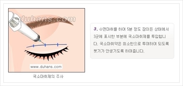[두한성형외과 경쟁력 눈성형, 쌍꺼풀 수술] - [퀵쌍꺼풀(부분절개법)의 수술 안내] 관련 이미지 4