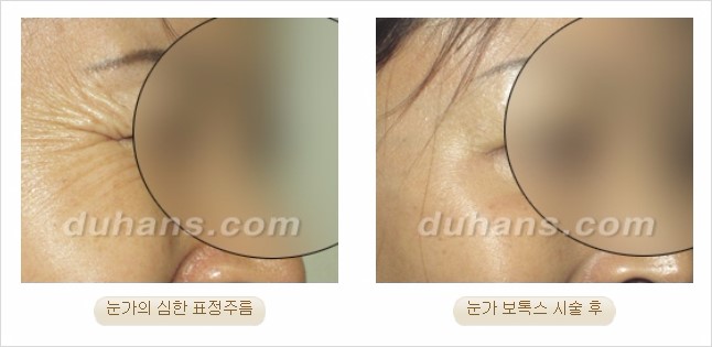 [두한성형외과 경쟁력 Quick 주름성형] - [주름교정을 위한 간편한 보톡스(보툴리눔톡신)] 관련 이미지 6