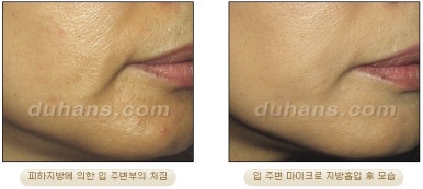 [두한성형외과 안전한 지방흡입] - [얼굴지방흡입] 관련 이미지 30
