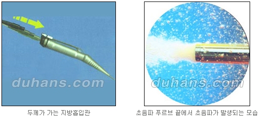 [Duhan Plastic Surgery Simple Liposuction] - [Liposuction for Obesity] image 5