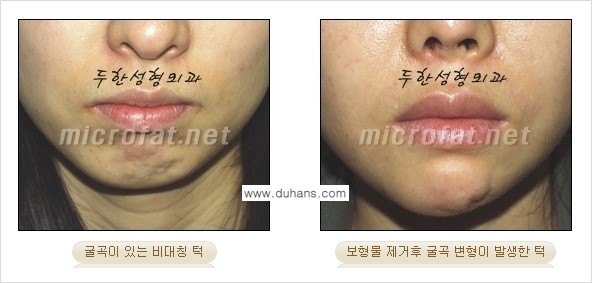 [두한성형외과 경쟁력 미세지방이식] - [부드럽고 아름다운 얼굴윤곽선 턱(하악부) 미세지방이식 안내] 관련 이미지 2