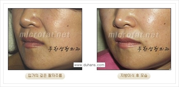 [두한성형외과 경쟁력 지방이식] - [입가주름, 팔자주름 미세지방이식의 안내] 관련 이미지 11