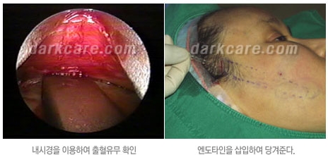 Duhan Plastic Surgery Combo Program - Dark Circles and Lifting image 12