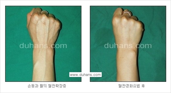 [두한성형외과 정맥 혈관 확장으로 인한 피부개선] - [손, 팔 혈관 확장] 관련 이미지 14