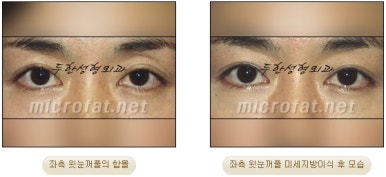 [Doohan Plastic Surgery Autologous Fat Grafting] - [Sunken Eye Fat Grafting] image 30