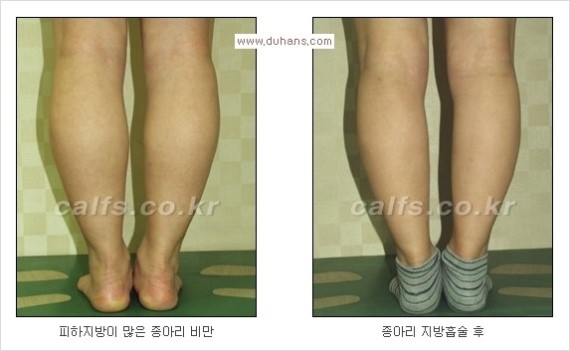 [두한성형외과 경쟁력 종아리성형 리더] - [종아리 성형 안내] 관련 이미지 14