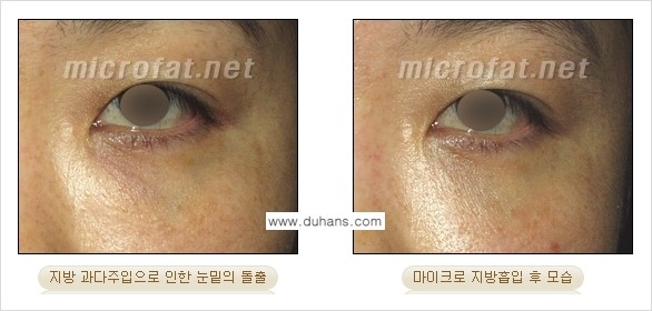 [두한성형외과 경쟁력 미세지방이식] - [미세지방이식 부작용 종류와 교정방법 안내] 관련 이미지 13