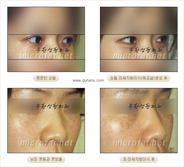 [두한성형외과] - [두한 지방이식의 자부심 콜펫(Col-fat)지방이식] 관련 이미지 7