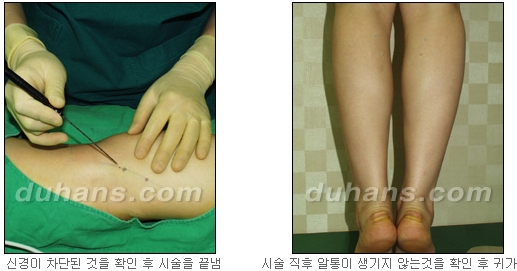 [두한성형외과 종아리 퇴축] - [종아리 퇴축술 재발 재수술] 관련 이미지 12