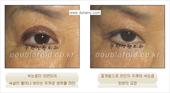 [두한성형외과 경쟁력 쌍꺼풀 재수술, 극한 눈재수술] - [쌍꺼풀 재수술 방법 - 속눈썹 외반] 관련 이미지 4