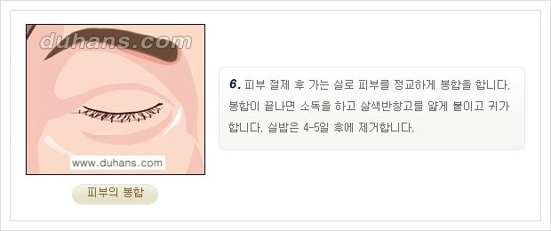 [두한성형외과 경쟁력 안검성형] - [젊은 눈매 하안검 성형술 안내] 관련 이미지 8