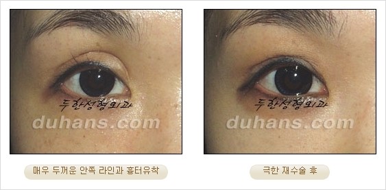 [두한성형외과 경쟁력 쌍꺼풀 재수술 리더 ] - [쌍꺼풀 재수술 과정, 쌍꺼풀 재수술 실패의 원인, 극한 재수술] 관련 이미지 10