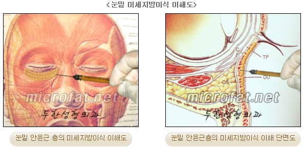 [두한성형외과 지방이식] - [다크써클, 눈​밑주름] 관련 이미지 9