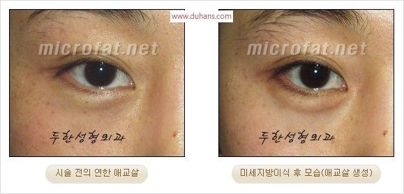 ​﻿[두한성형외과 경쟁력 지방이식] - [눈밑 애교살 시술을 위한 미세지방이식] 관련 이미지 23